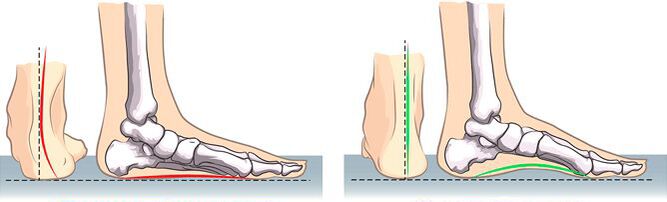 Flat valgus and normal foot