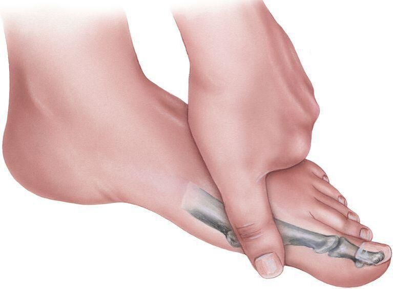 Pain in the foot with plano-valgus deformity
