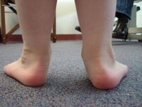 Flat valgus foot deformity in a child