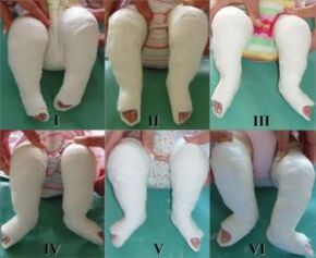 Plastering procedures, each of which changes the position of the foot