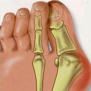 The reasons for Valgus