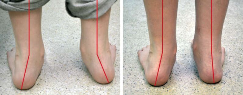 Valgus legs