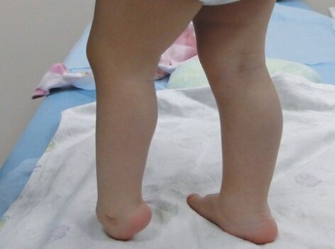 The first symptoms of valgus deformation of the foot
